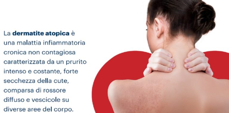 A Battipaglia visite dermatologiche per chi soffre di dermatite atopica